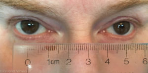 An image of a persons eyes with a ruler to measure the interpupillary distance